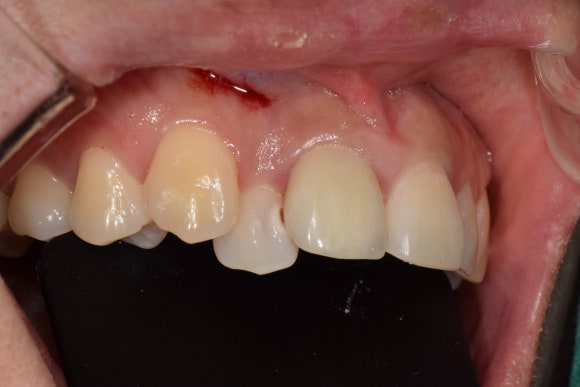 [치료사례] 덧니에 생긴 충치 어떻게 치료하나요? (신촌치과, 충치치료, 레진치료) 관련 이미지 2