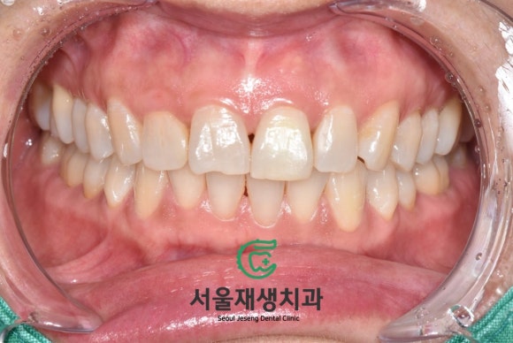 [치아미백] 예전에 다친 치아가 최근에 변색됐어요. 어떻게 해결하나요? (서울재생치과) 관련 이미지 9