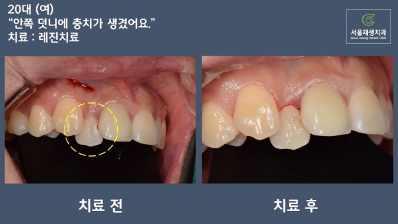 [치료사례] 덧니에 생긴 충치 어떻게 치료하나요? (신촌치과, 충치치료, 레진치료) 관련 이미지 6