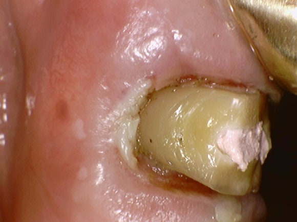 부러진 치아를 살려서 쓰는 법 (잇몸성형과 포스트식립) 관련 이미지 6