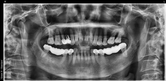 [임플란트] 좁은 공간에도 정밀하게, 1mm의 정교함을 잡은 임플란트 치료 관련 이미지 3