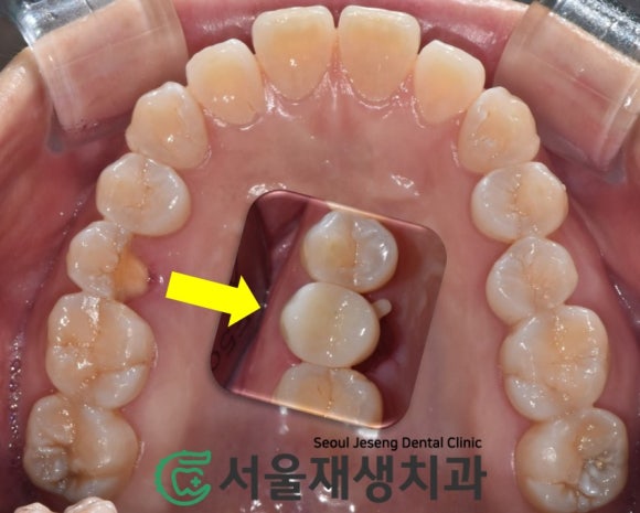 [치아파절] 밥 먹다가 이가 반으로 쪼개졌어요....이런 치아도 살릴 수 있나요? (깨진 치아 치료하기, 신촌 서울재생치과) 관련 이미지 10