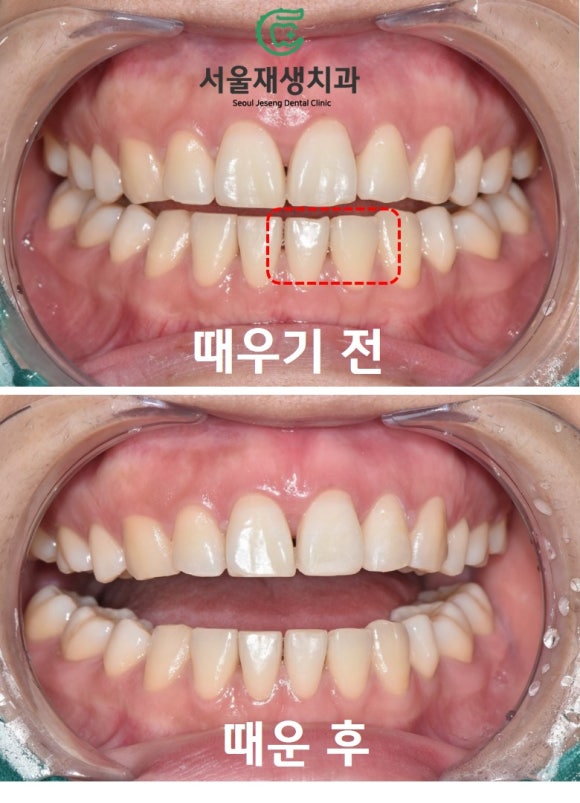 [깨진앞니치료] 살짝 다듬고, 살짝 때우고! (서울재생치과 신촌) 관련 이미지 10