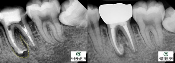 재신경치료의 치료 기간, 내원 횟수, 간격 (신촌치과, 서울재생치과, 서울대 보존과 전문의) 관련 이미지 11
