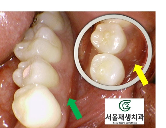 [치외치신경치료] 뿌리 끝 염증이 커서 발치해야된대요! 치아 머리에 볼~록! 알고보면 무서운 작은 혹 (서울재생치과) 관련 이미지 17