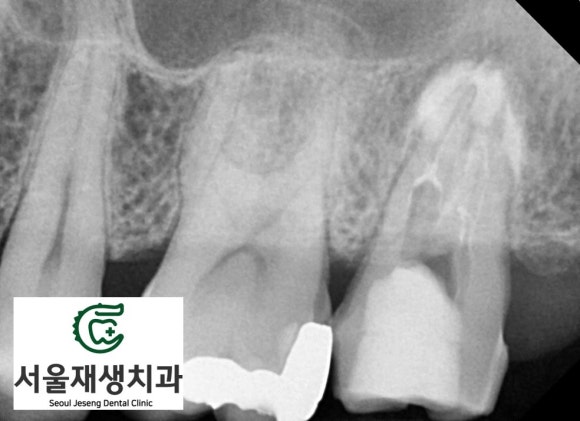 [재신경치료] 40대 남성, 윗 어금니 신경치료 후 상악동까지 염증이 전파된 사례 (서울재생치과 미세현미경치료) 관련 이미지 8