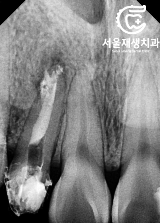 [재신경치료] 소중한 내 앞니...재신경치료로 다시 한 번 살려 쓸 수 있습니다. (서울재생치과, 현미경신경치료) 관련 이미지 11