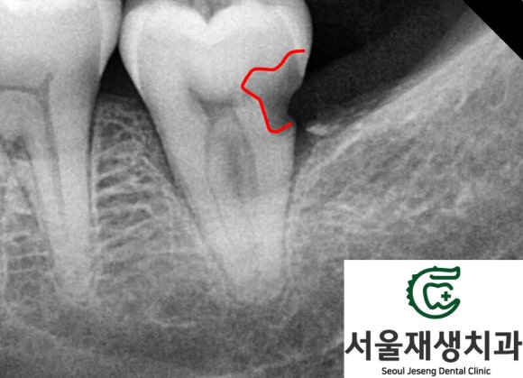 치아 뿌리에 생긴 충치...살릴 수 있는 방법 없을까요? 현미경을 이용하여 보다 꼼꼼하게! 관련 이미지 5
