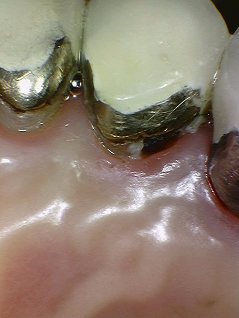 크라운 다음은 임플란트인가요...? (크라운 밑으로 생긴 충치, 크라운 다음엔 어떤 치료를...?, 자연치아 살리는 치과, 서울재생치과) 관련 이미지 4