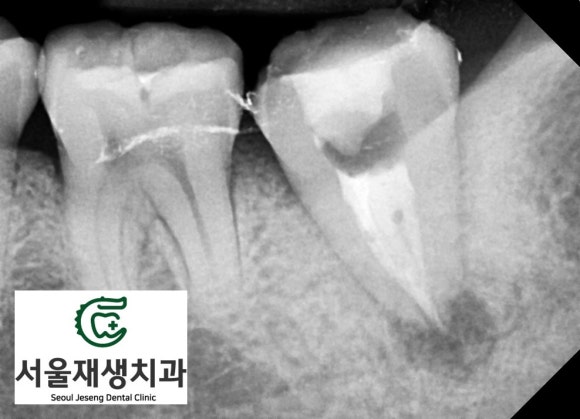 [재신경치료] 치과 종사자도 찾아오는 신경치료 전문치과, 서울재생치과! 관련 이미지 7