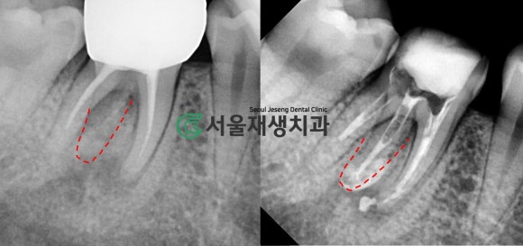 [재신경치료] 신경치료 받은 치아가 붓고 아파요! 현미경과 CT의 도움으로 다시 한 번 꼼꼼하게~ 관련 이미지 11
