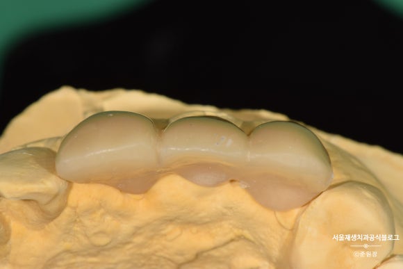 [치아외상] 부러진 앞니, 발치가 답인가요? (사고로 부러진 치아, 외과적정출술로 살리기) 관련 이미지 25