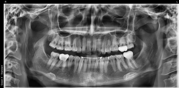 [신경치료] 예전에 크라운을 씌운 치아인데 갑자기 시려졌어요. 관련 이미지 3