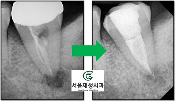 [재신경치료] 치과 종사자도 찾아오는 신경치료 전문치과, 서울재생치과! 관련 이미지 11
