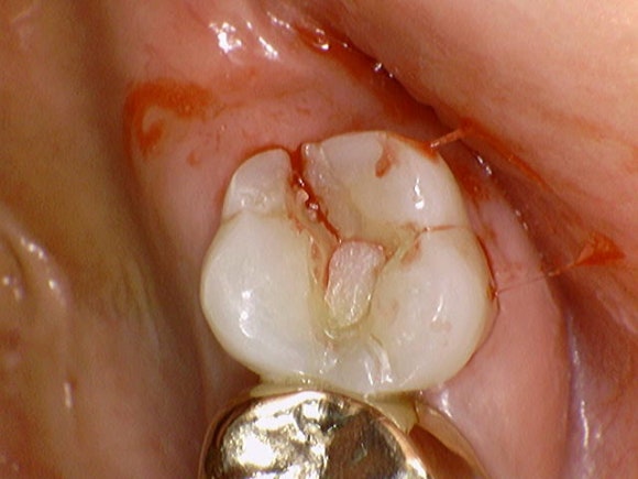 [Implants] Can Teeth Like These Be Saved? (Broken Teeth, Split Teeth) image 3