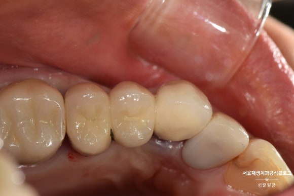 충치나 파절로 짧아진 치아도 다시 보자! (의도적 재식술/치아정출술 후 브릿지치료) 관련 이미지 14