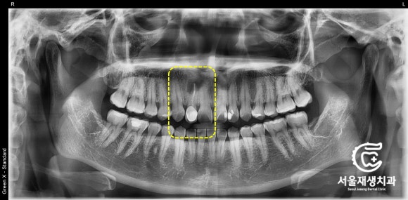 [재신경치료] 소중한 내 앞니...재신경치료로 다시 한 번 살려 쓸 수 있습니다. (서울재생치과, 현미경신경치료) 관련 이미지 3
