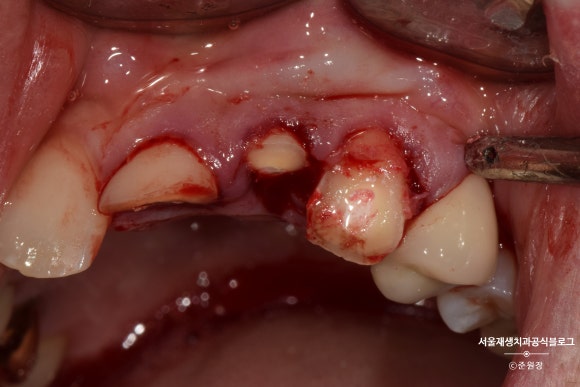 [치아외상] 부러진 앞니, 발치가 답인가요? (사고로 부러진 치아, 외과적정출술로 살리기) 관련 이미지 9