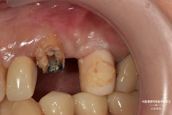 충치나 파절로 짧아진 치아도 다시 보자! (의도적 재식술/치아정출술 후 브릿지치료) 관련 이미지 10