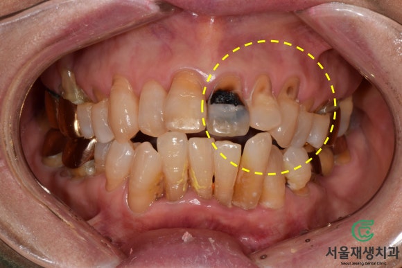 [치료사례] 잇몸 패임 때문에 음식이 많이끼고 충치가 생겨요. 관련 이미지 3