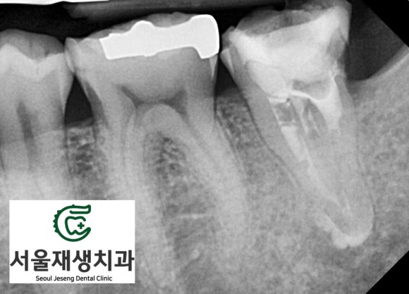 [재신경치료] 예전에 신경치료 받은 치아가 갑자기 너무 아파요! (서울재생치과, 현미경신경치료) 관련 이미지 6