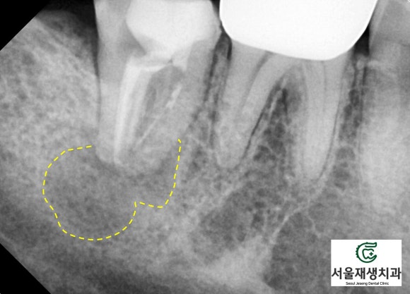 재신경치료의 치료 기간, 내원 횟수, 간격 (신촌치과, 서울재생치과, 서울대 보존과 전문의) 관련 이미지 5