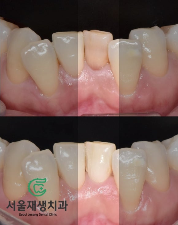[치아미백] 예전에 부딪힌 앞니가 까맣게 변했어요. 신경이 죽은 치아를 하얗게 돌려놓기! (서울재생치과) 관련 이미지 11