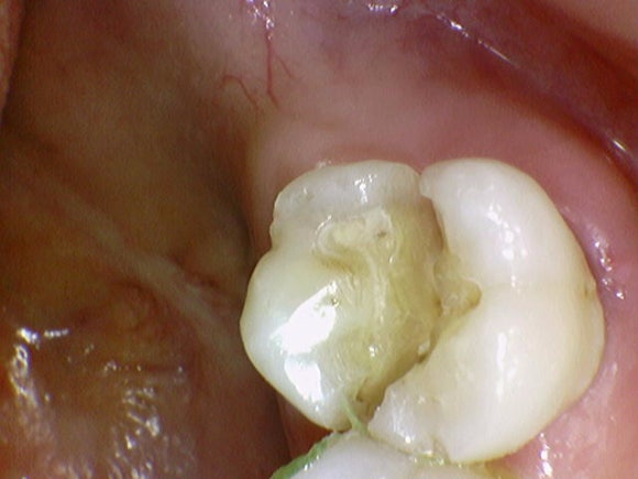 [Implants] Can Teeth Like These Be Saved? (Broken Teeth, Split Teeth) image 6