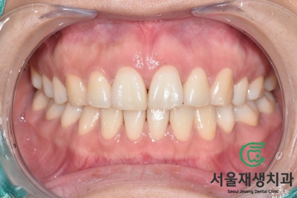 [깨진앞니치료] 살짝 다듬고, 살짝 때우고! (서울재생치과 신촌) 관련 이미지 3