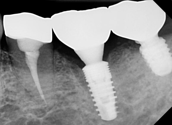 [임플란트] 재신경치료를 시도할 수 없을 때. 뼈이식 없는 임플란트 시술로 간편하게. 관련 이미지 13
