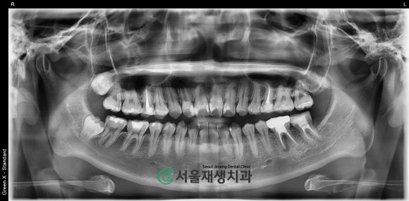 [재신경치료] 예전에 신경치료 받은 치아....치근단 절제술이나 발치를 해야 한다는데요?! (신촌 서울재생치과) 관련 이미지 4