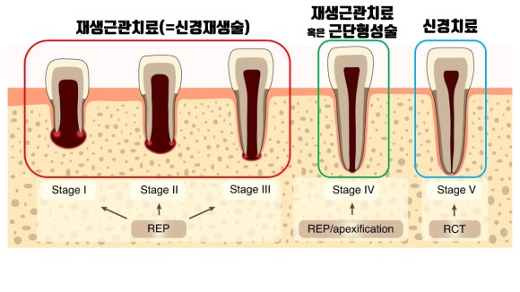 [재생근관치료] 이가 난지 얼마 안 됐는데 신경이 죽었대요...(소아 치아 외상, 치수 괴사, 미성숙 영구치, 신경재생술, REP, 치료기간, MTA 신경치료, 내원횟수) 관련 이미지 4