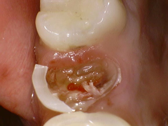 [치아살리기] 뿌리만 남은 치아의 치료 관련 이미지 6