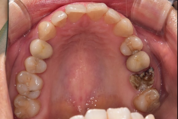 [치아살리기] 부러진 치아를 빼고 임플란트해야 한대요. 관련 이미지 4
