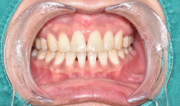 치아가 변색되면 무조건 크라운을 해야 하나요? (치아 미백, 실활치 미백, 신경치료 후 미백, 신촌치과추천,서울재생치과) 관련 이미지 13