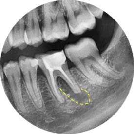 [재신경치료] 예전에 신경치료 받은 치아가 갑자기 붓고 아파요! (현미경을 통해 정확하고 섬세하게 재신경치료 하기) 관련 이미지 9