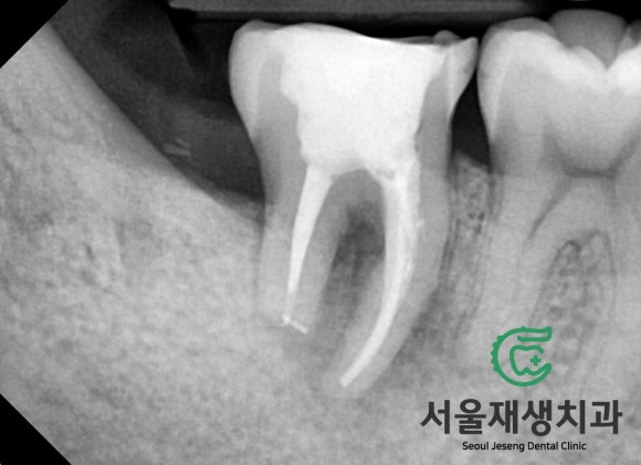 [고난이도 신경치료] 사랑니 때문에 뿌리가 흡수되어 버린 치아...살릴 수 있나요? 관련 이미지 7