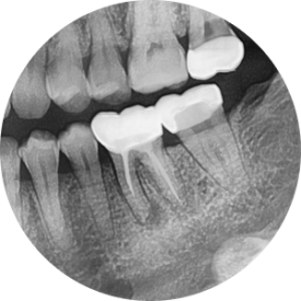 [재신경치료] 예전에 신경치료 받은 치아가 갑자기 붓고 아파요! (현미경을 통해 정확하고 섬세하게 재신경치료 하기) 관련 이미지 22