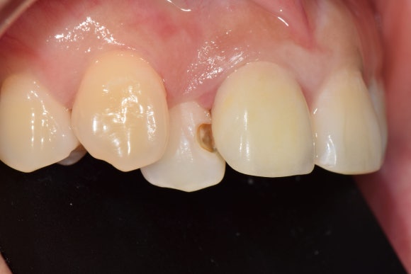 [치료사례] 덧니에 생긴 충치 어떻게 치료하나요? (신촌치과, 충치치료, 레진치료) 관련 이미지 4