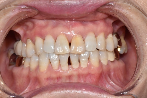 치아가 변색되면 무조건 크라운을 해야 하나요? (치아 미백, 실활치 미백, 신경치료 후 미백, 신촌치과추천,서울재생치과) 관련 이미지 5