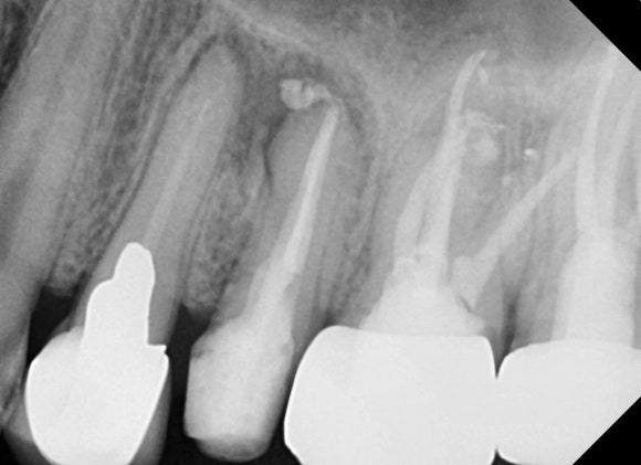 [재신경치료] 신경치료 받은 치아가 아프고 흔들려요 (ft. Zeiss미세현미경) 관련 이미지 4