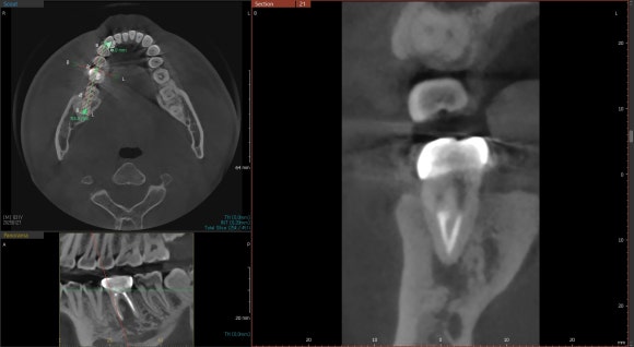 [재신경치료] 6개월 전에 신경치료한 치아에서 고름이 나와요. 관련 이미지 6
