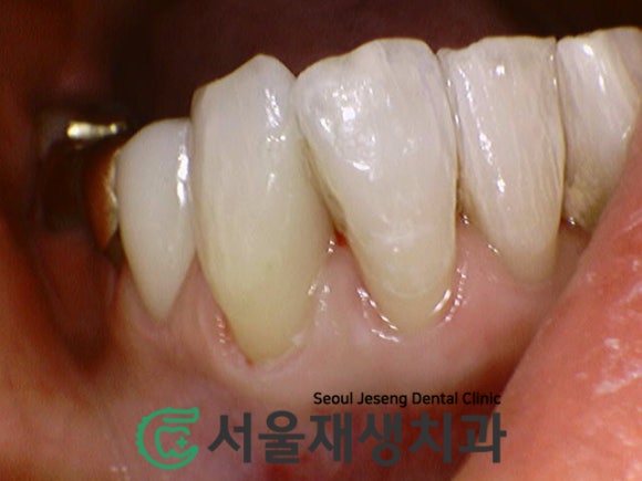 [충치치료] 앞니 충치&middot;오래되어 변색된 재료를 레진으로 해결! 관련 이미지 4