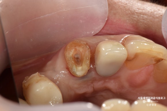 충치나 파절로 짧아진 치아도 다시 보자! (의도적 재식술/치아정출술 후 브릿지치료) 관련 이미지 11