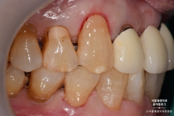 잇몸 패임, 무슨 재료로 때우나요? 레진과 글라스아이오노머(GI)로 치경부마모증 치료하기 (서울재생치과,신촌치과) 관련 이미지 20