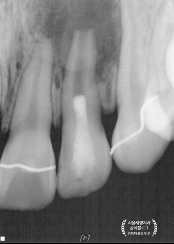 [재생근관치료] 이가 난지 얼마 안 됐는데 신경이 죽었대요...(소아 치아 외상, 치수 괴사, 미성숙 영구치, 신경재생술, REP, 치료기간, MTA 신경치료, 내원횟수) 관련 이미지 13