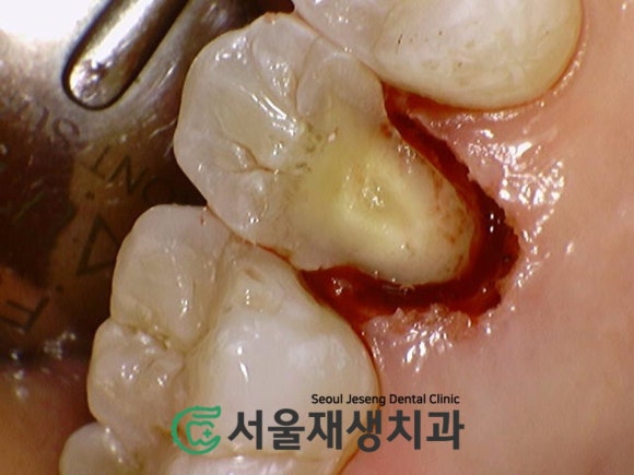 [치아파절] 밥 먹다가 이가 반으로 쪼개졌어요....이런 치아도 살릴 수 있나요? (깨진 치아 치료하기, 신촌 서울재생치과) 관련 이미지 5
