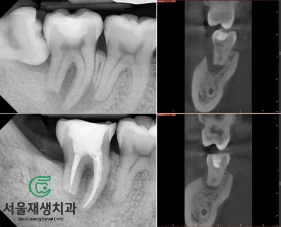 [치료사례] 고난이도 신경치료 (뿌리가 흡수된 치아의 신경치료, 서울재생치과) 관련 이미지 1