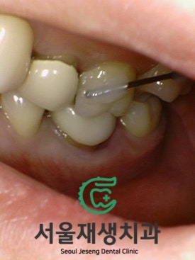 치과에서 치료하는 치아가 아닌 반대편 치아를 갈아내는 이유는? 장기 치료에 반드시 필요한 "정출방지 치아고정"에 대해 알아봅시다. 관련 이미지 11