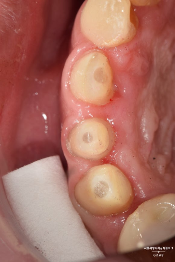 [치아외상] 부러진 앞니, 발치가 답인가요? (사고로 부러진 치아, 외과적정출술로 살리기) 관련 이미지 21